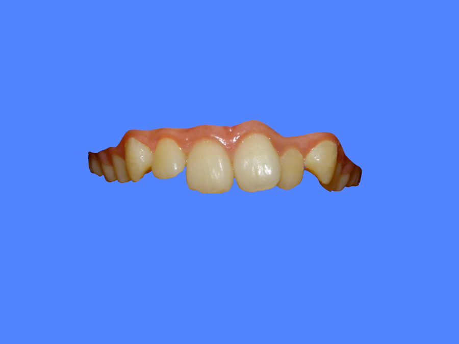 A patient with crooked front teeth